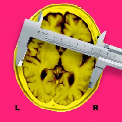 Mri Alzheimer Brain With Calipers