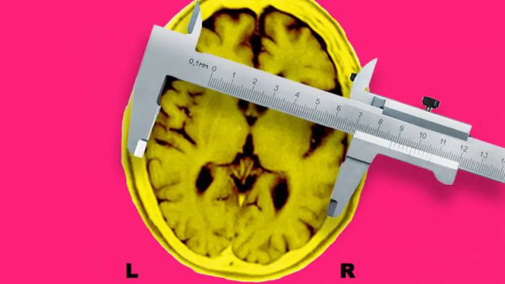 Mri Alzheimer Brain With Calipers