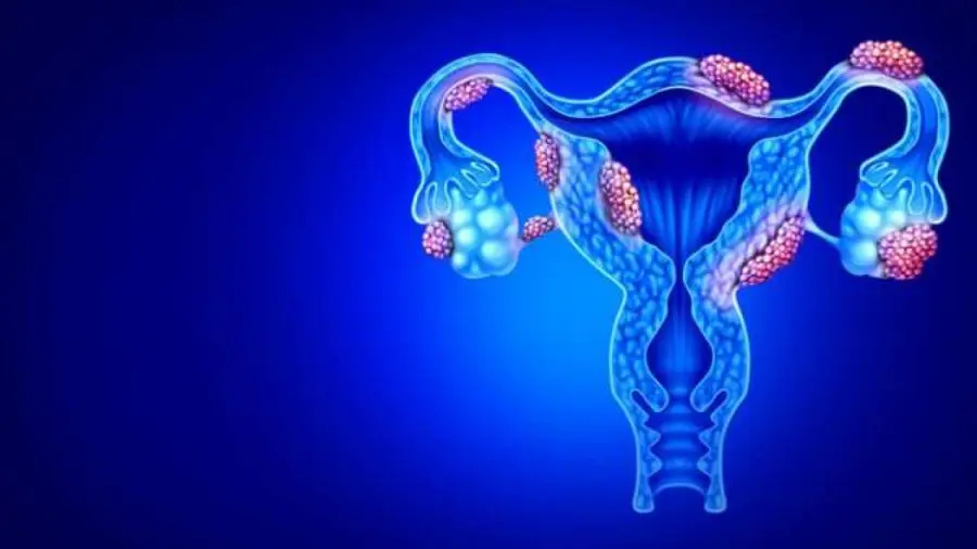Ai Endometriosis