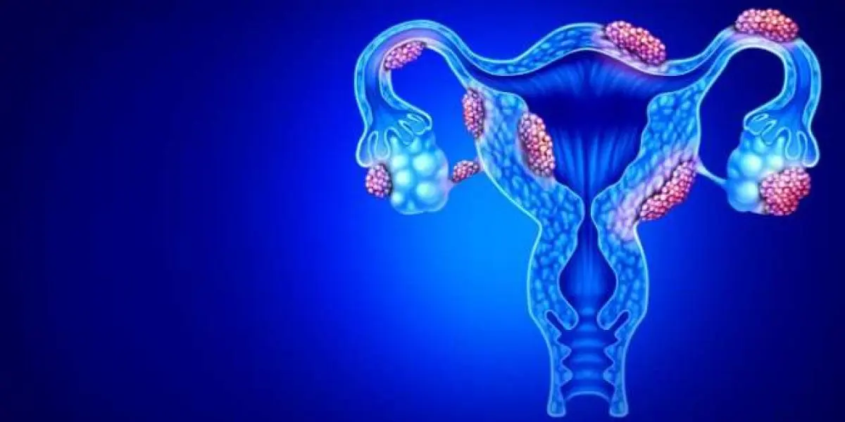 Ai Endometriosis